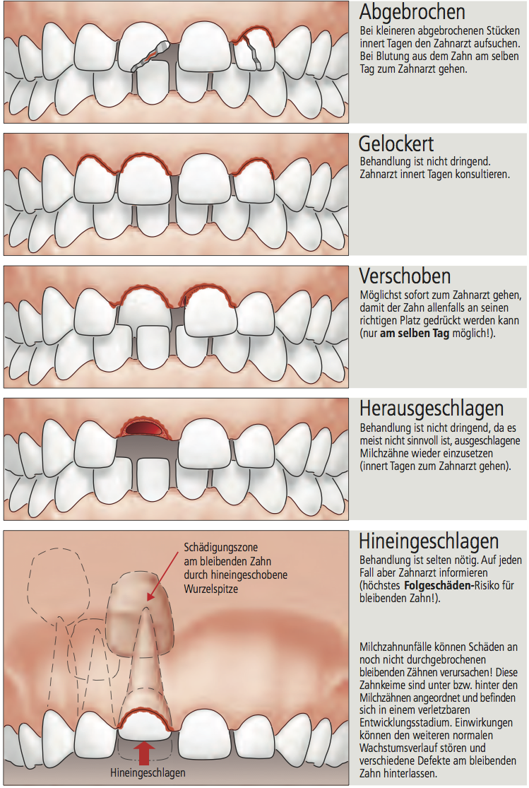 Zahn-Unfälle